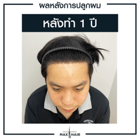 ตัวอย่างผลหลังการปลูกผม 1 ปี