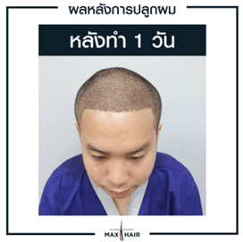 ตัวอย่างผลหลังการปลูกผม 1 วัน