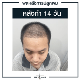 ตัวอย่างผลหลังการปลูกผม 14 วัน