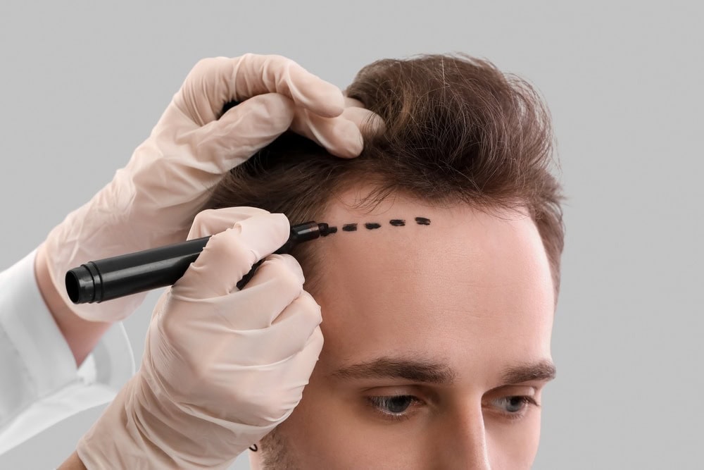 6 Facts You Should Know Before Hair Transplants | MAX HAIR