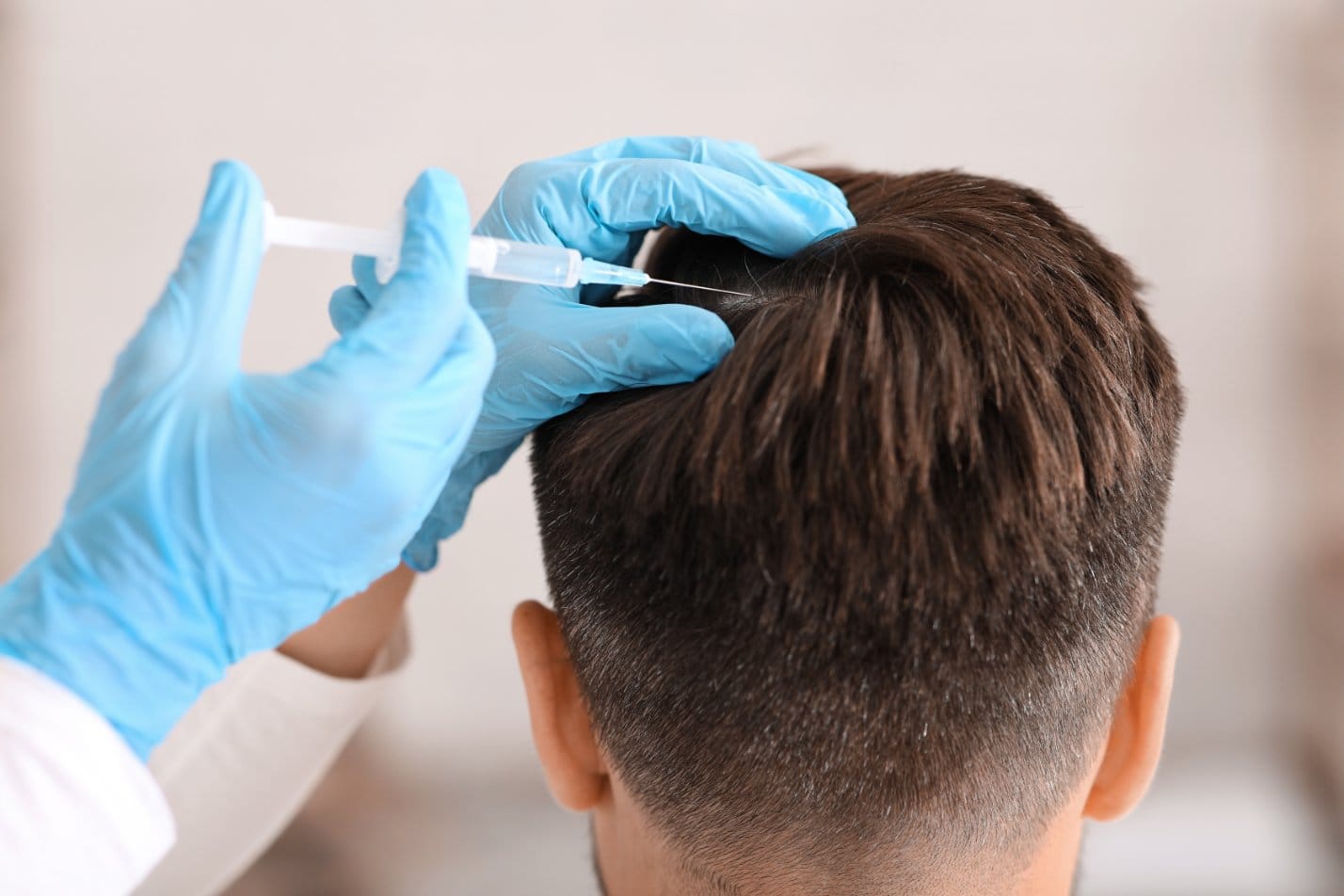 Doctor treating a patient with alopecia areata