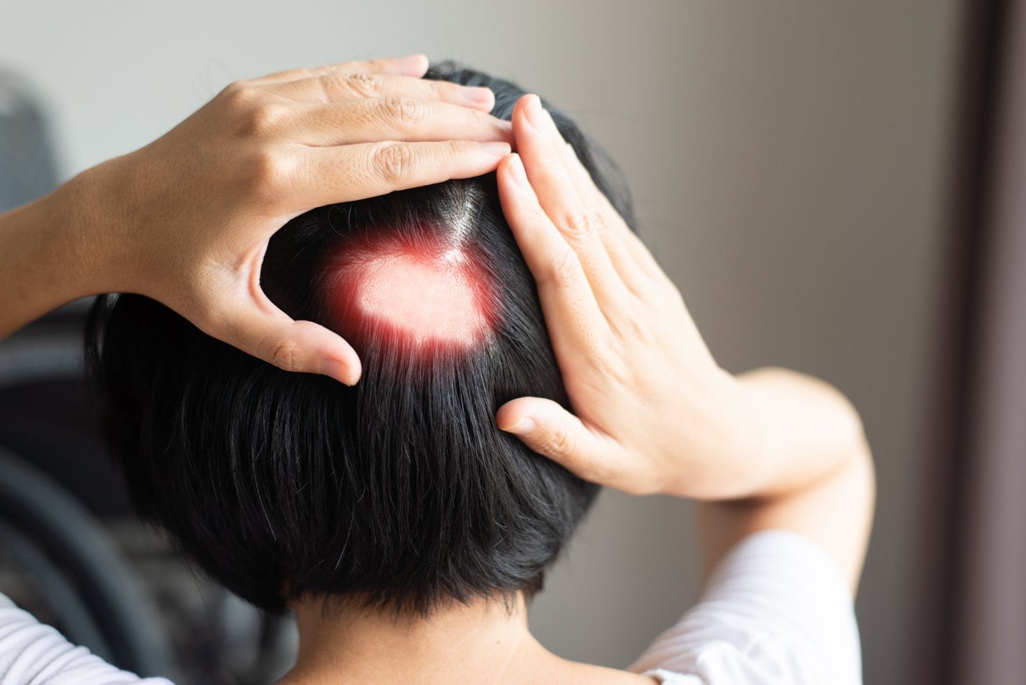 Woman experiencing symptoms of alopecia areata