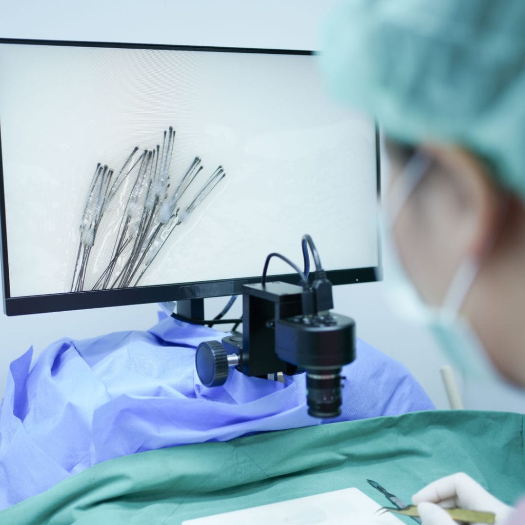 แพทย์กำลังทำการปลูกผมแบบ Long Hair Transplant อย่างระมัดระวัง