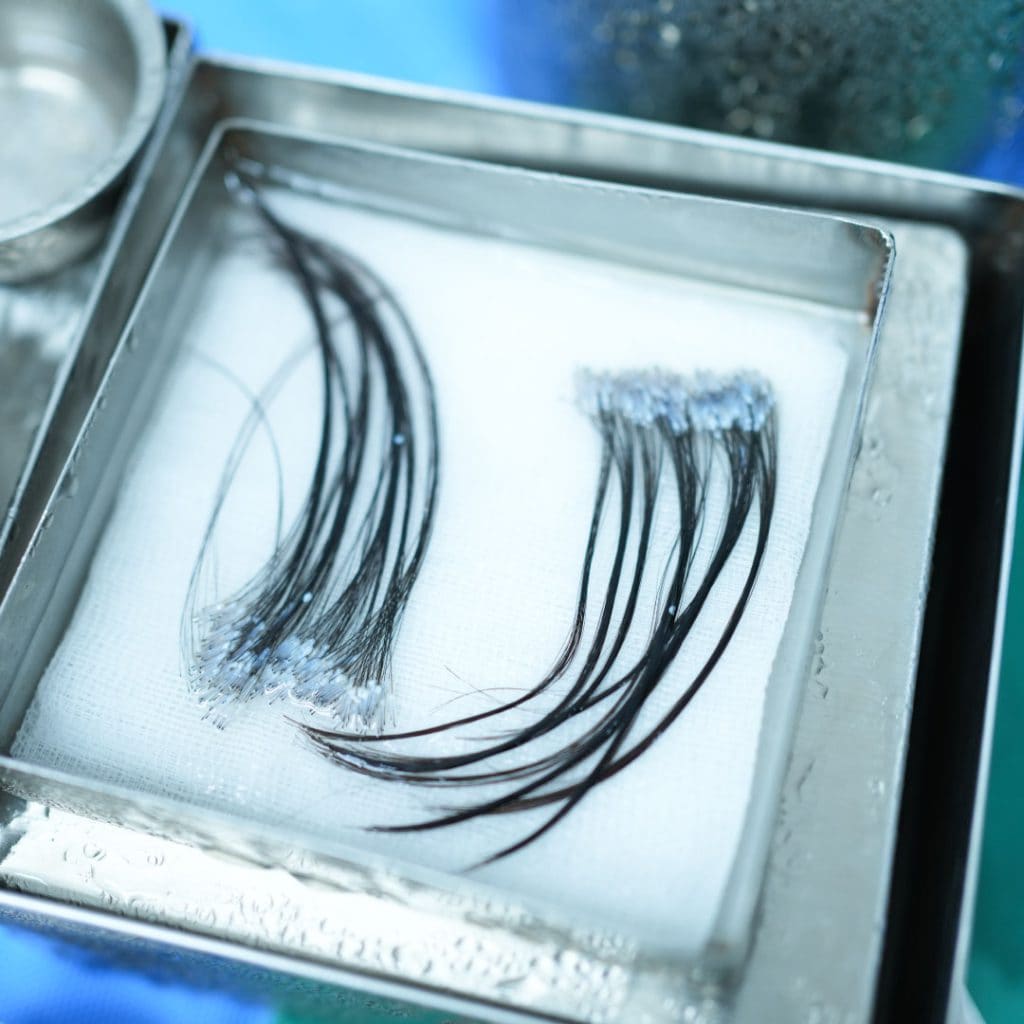 เส้นผมและรากผมที่เตรียมนำไปปลูกด้วยเทคนิค Long Hair Transplant
