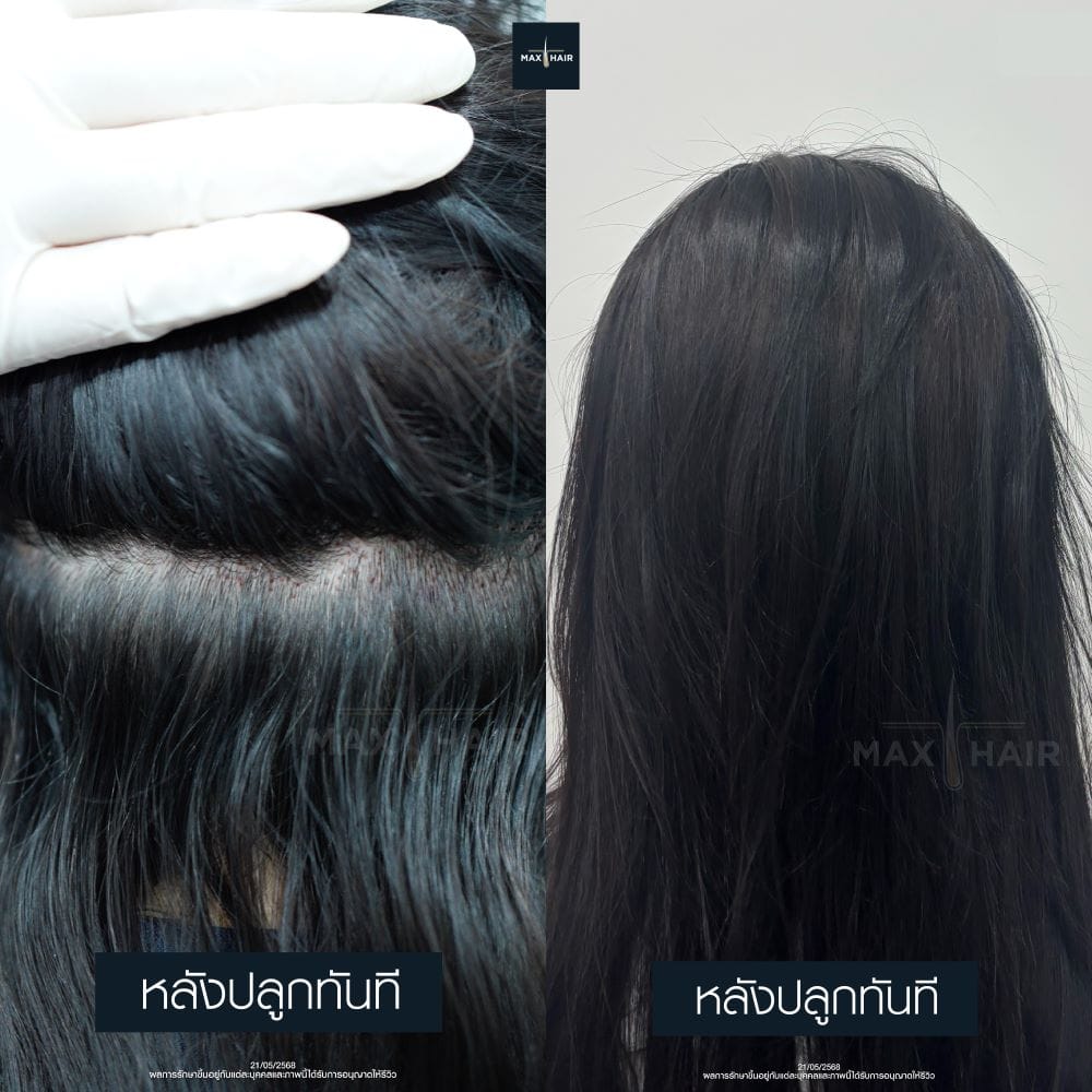 ภาพเปรียบเทียบผลลัพธ์การปลูกผม Long Hair ของคุณต้นหอม ศกุนตลา