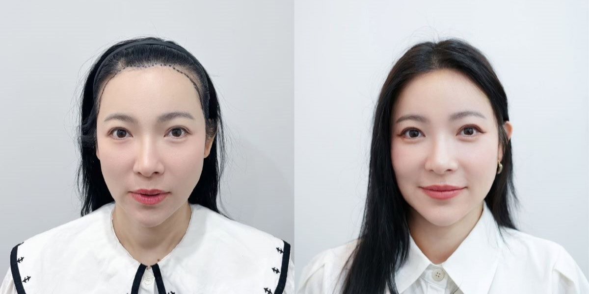 รีวิวปลูกผมผู้หญิงโดยคุณต้นหอม ศกุนตลา ด้วยเทคนิค Long Hair