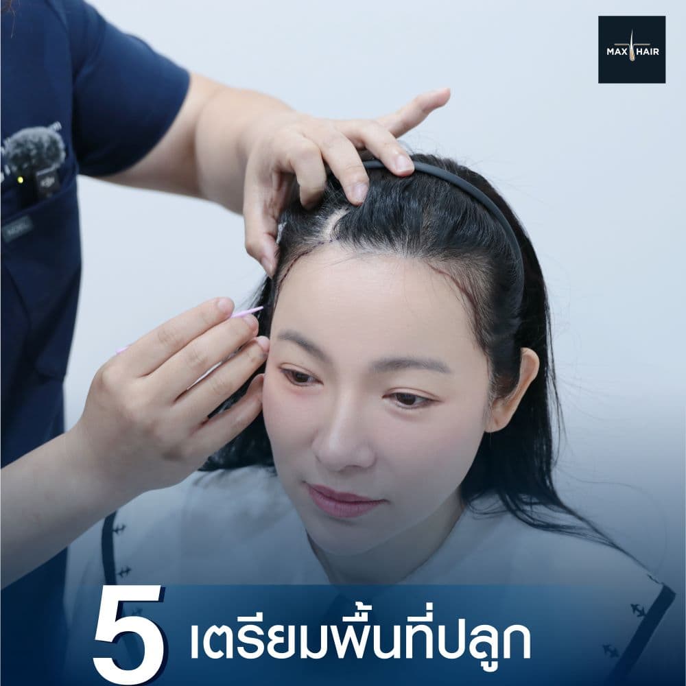 ขั้นตอนที่ห้าของการ Long Hair Transplant คือการเตรียมพื้นที่ปลูกผม