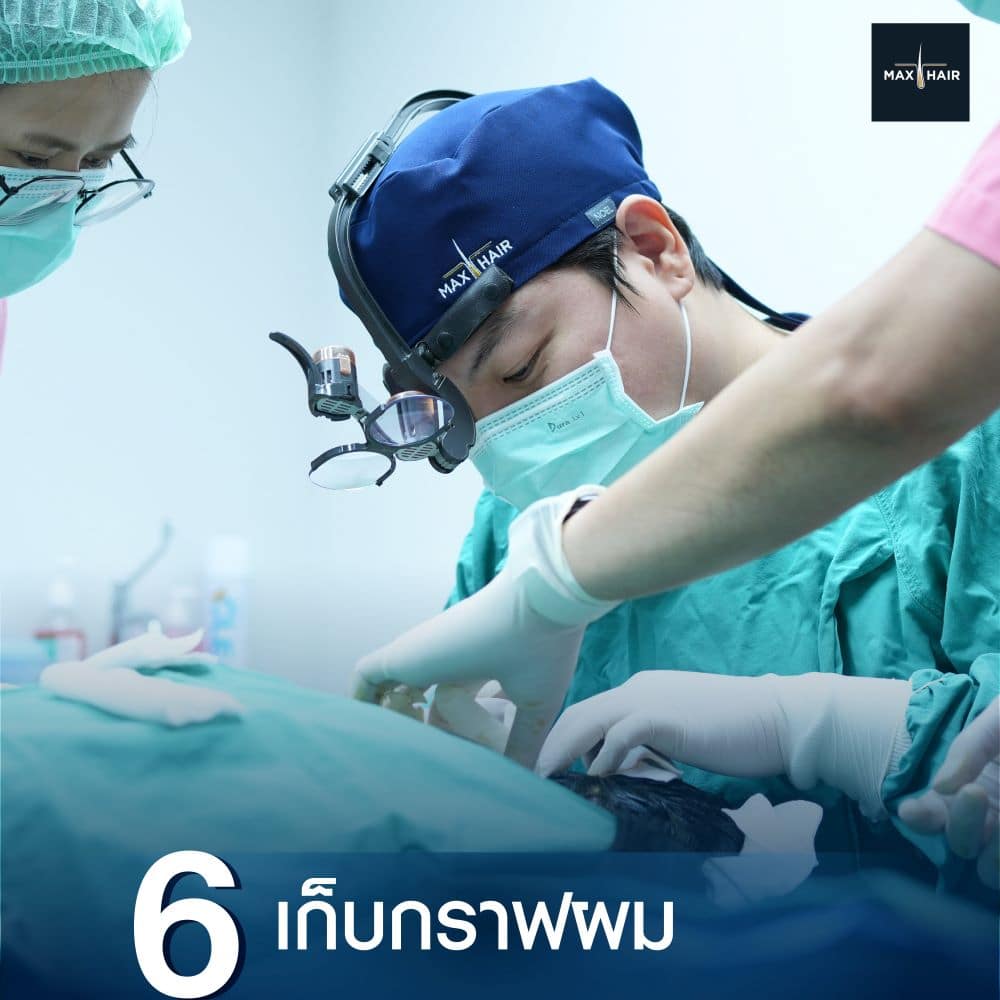 ขั้นตอนที่หกของการ Long Hair Transplant คือการเก็บกราฟผม