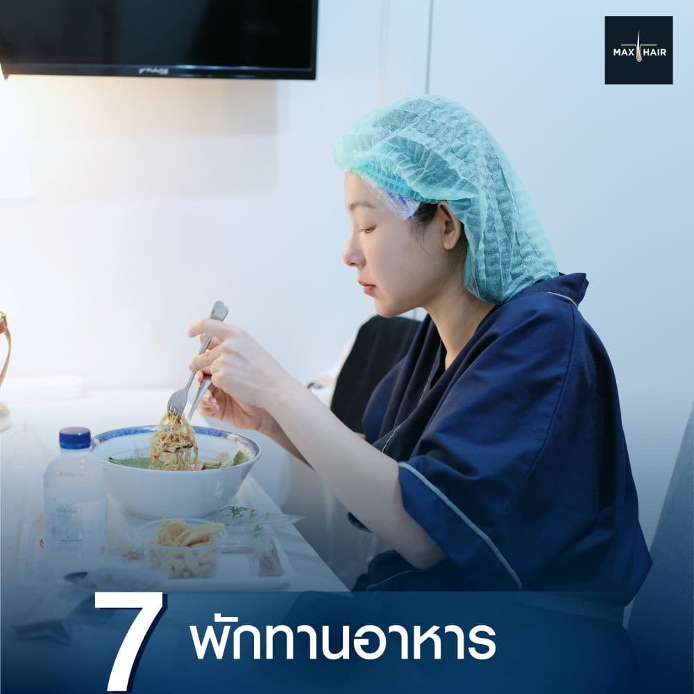 Long Hair Transplant มีการพักเบรกหลังเก็บกราฟผม