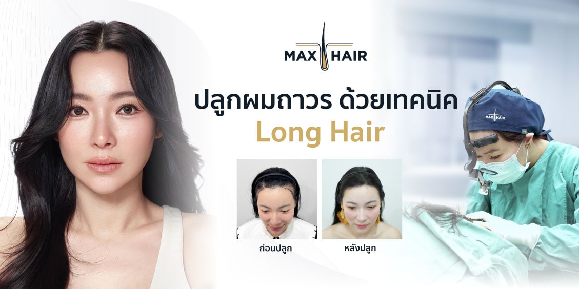 ภาพเปรียบเทียบก่อนและหลังการปลูกผมด้วยเทคนิค Long Hair
