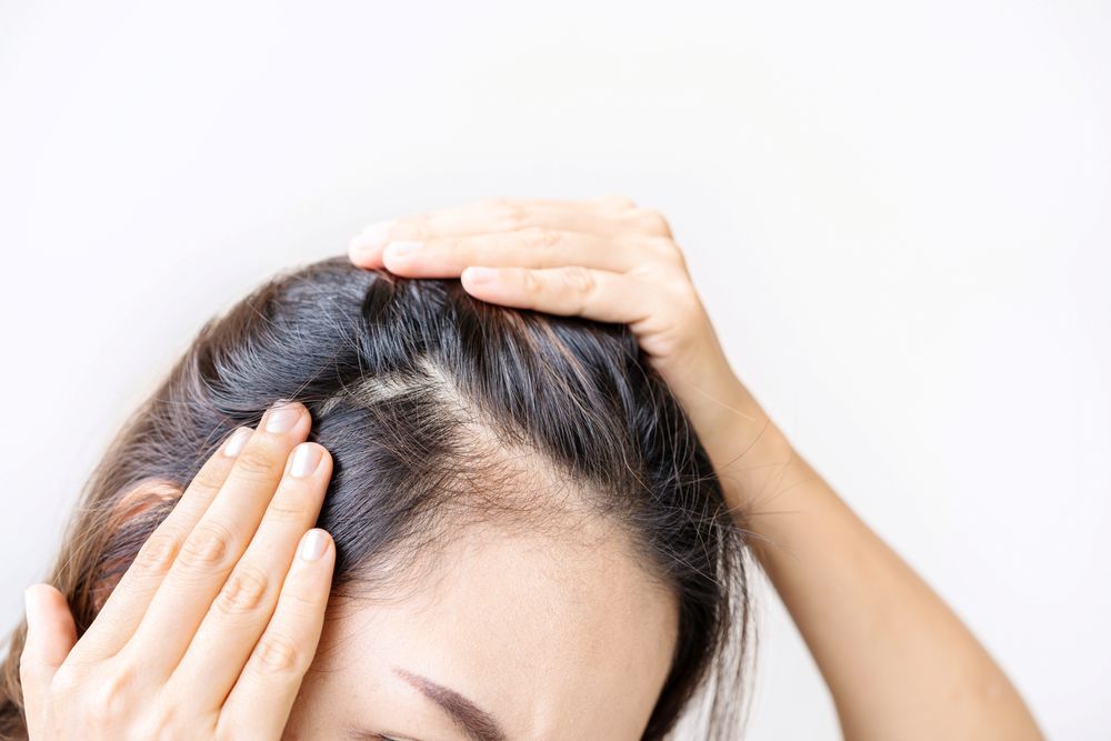 Haircuts for thinning hair women, hairstyles for hair loss female - Woman with receding hairline seeking hairstyles for women with receding hairlines