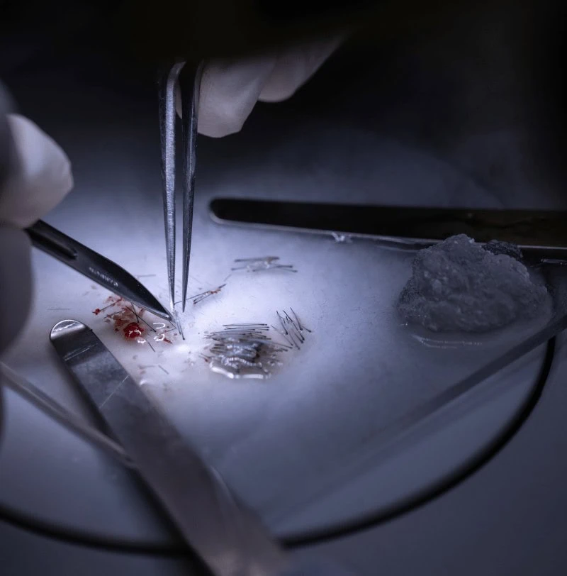 ภาพระยะใกล้ของแพทย์ที่กำลังถอนรากผม ซึ่งเป็นหนึ่งในขั้นตอนปลูกผม ไมโครกราฟ