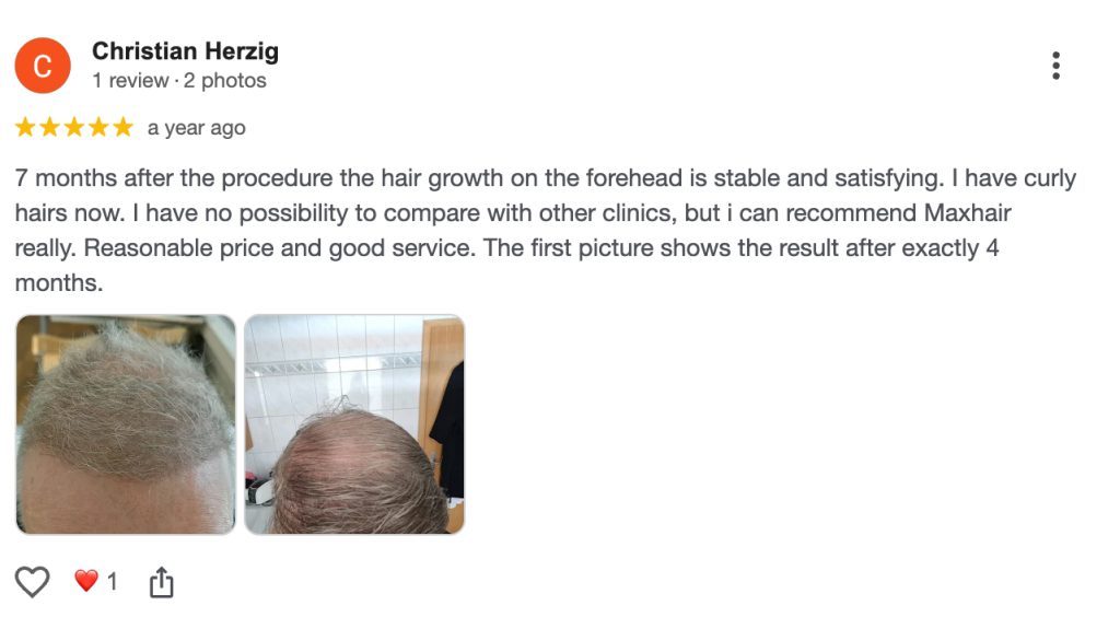 รีวิวปลูกผมจาก Christian Herzig