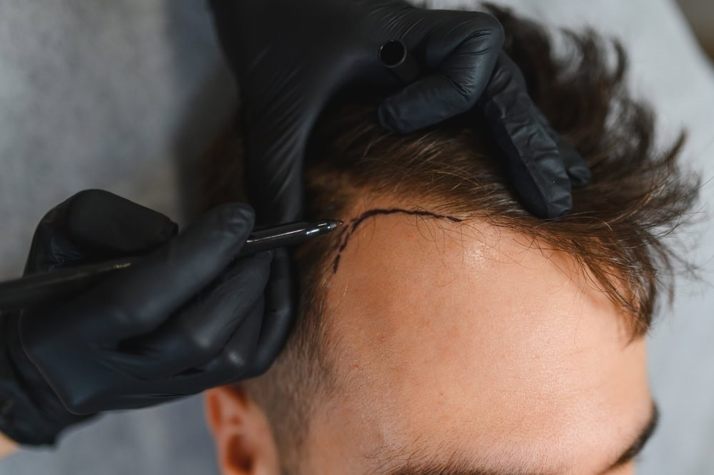 การปลูกผม แทนการใส่วิก เพื่อแก้ปัญหาผมบางก่อนวัย