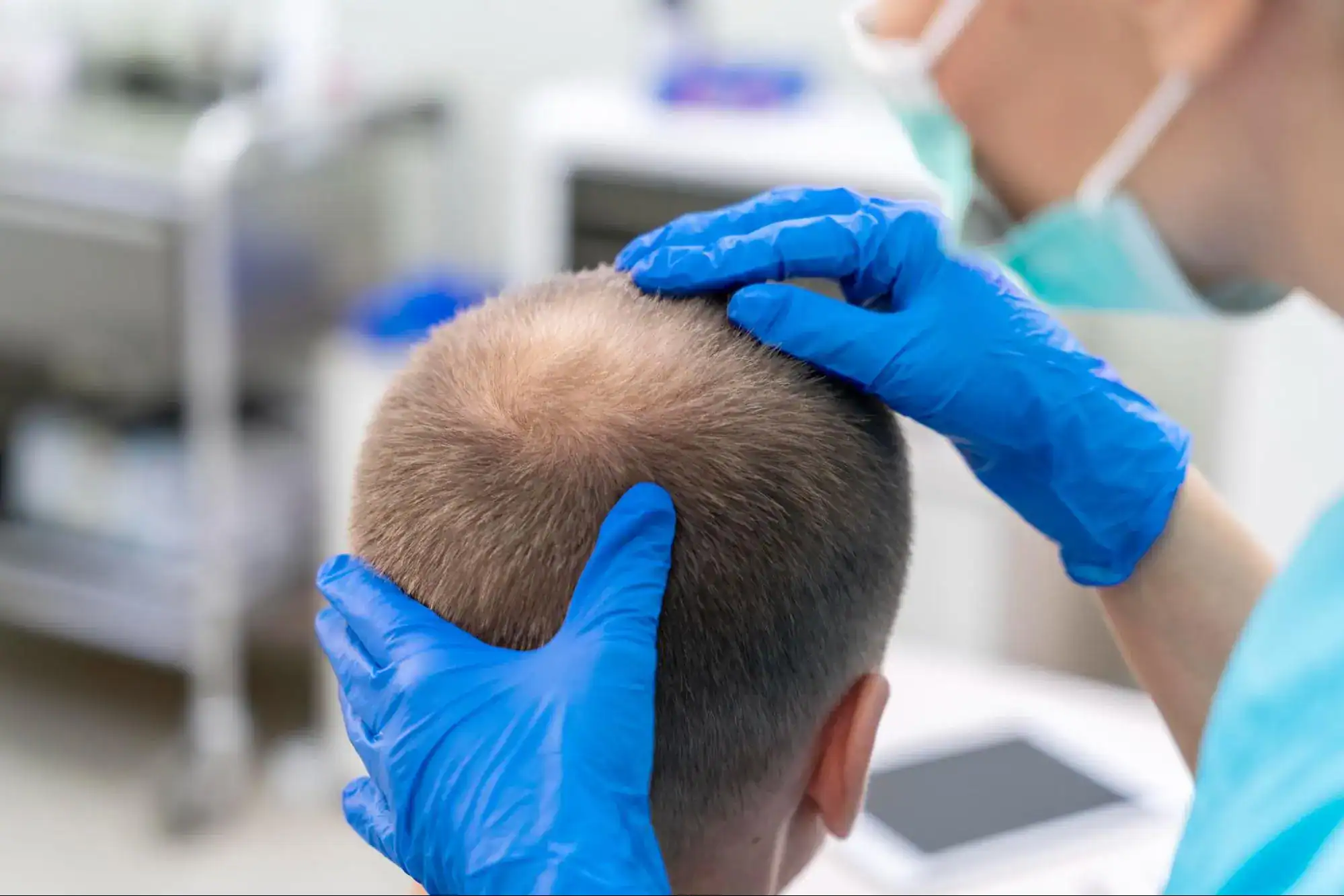 Baldness Hair Transplantation