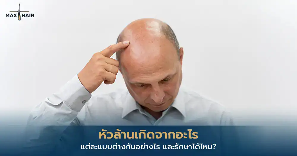 หัวล้าน
