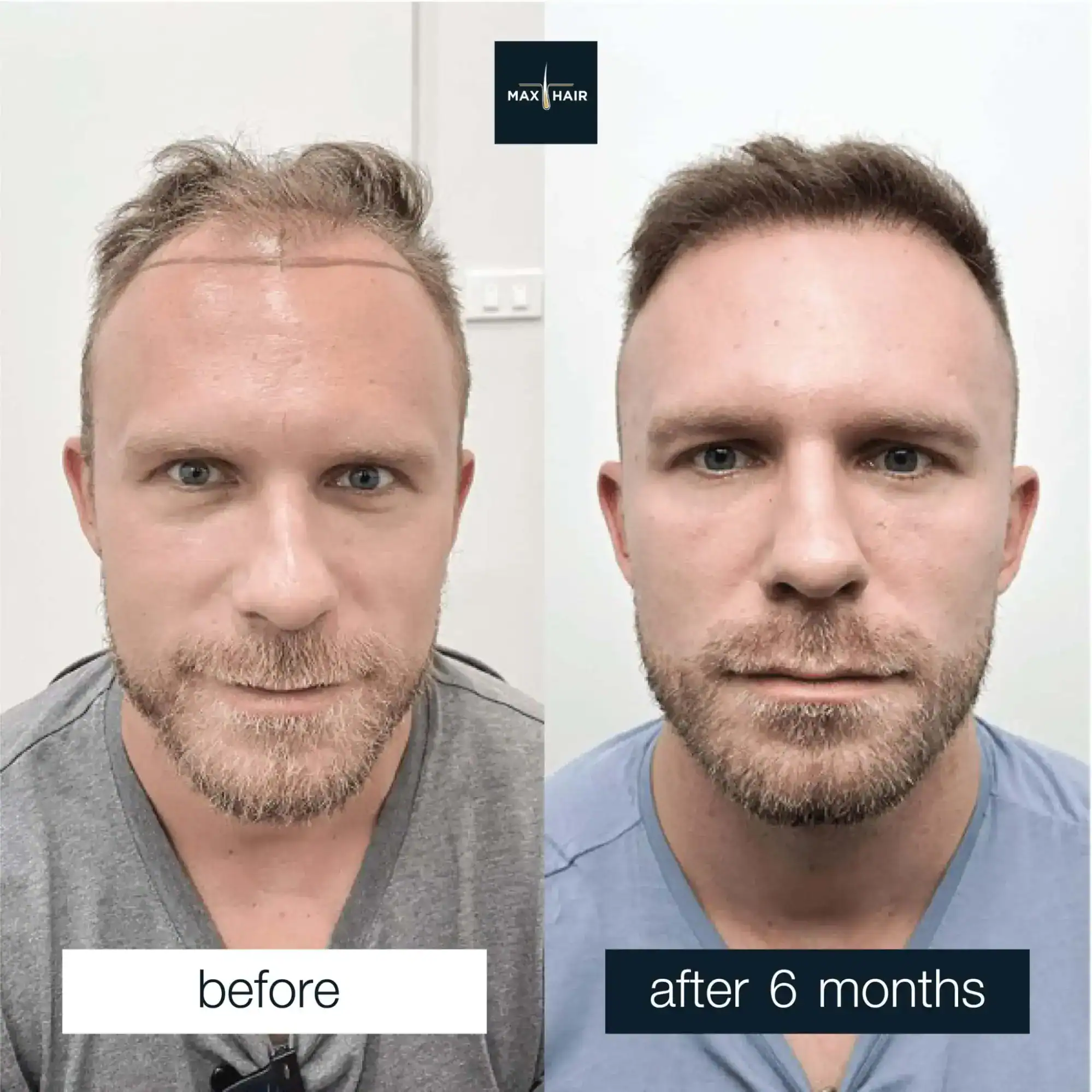 Hair Transplant Review
