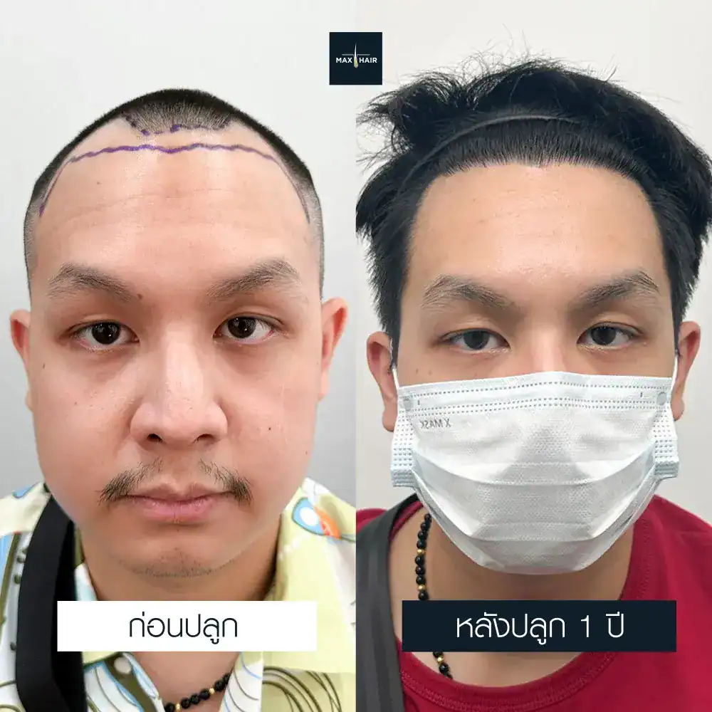 ปลูกผมรีวิว