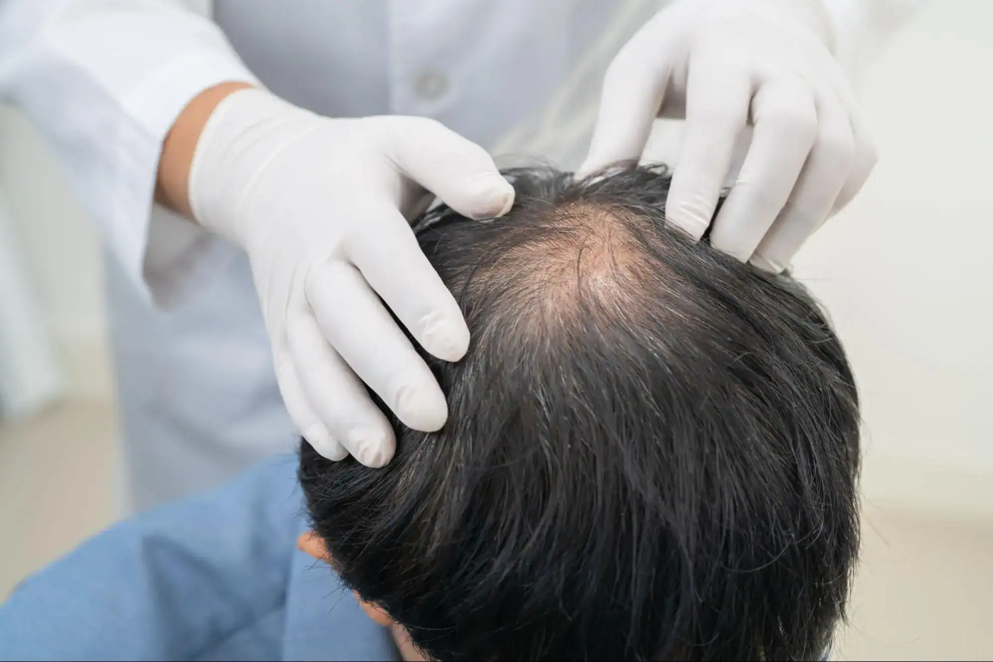 Hair Transplant thinning hair and hair loss