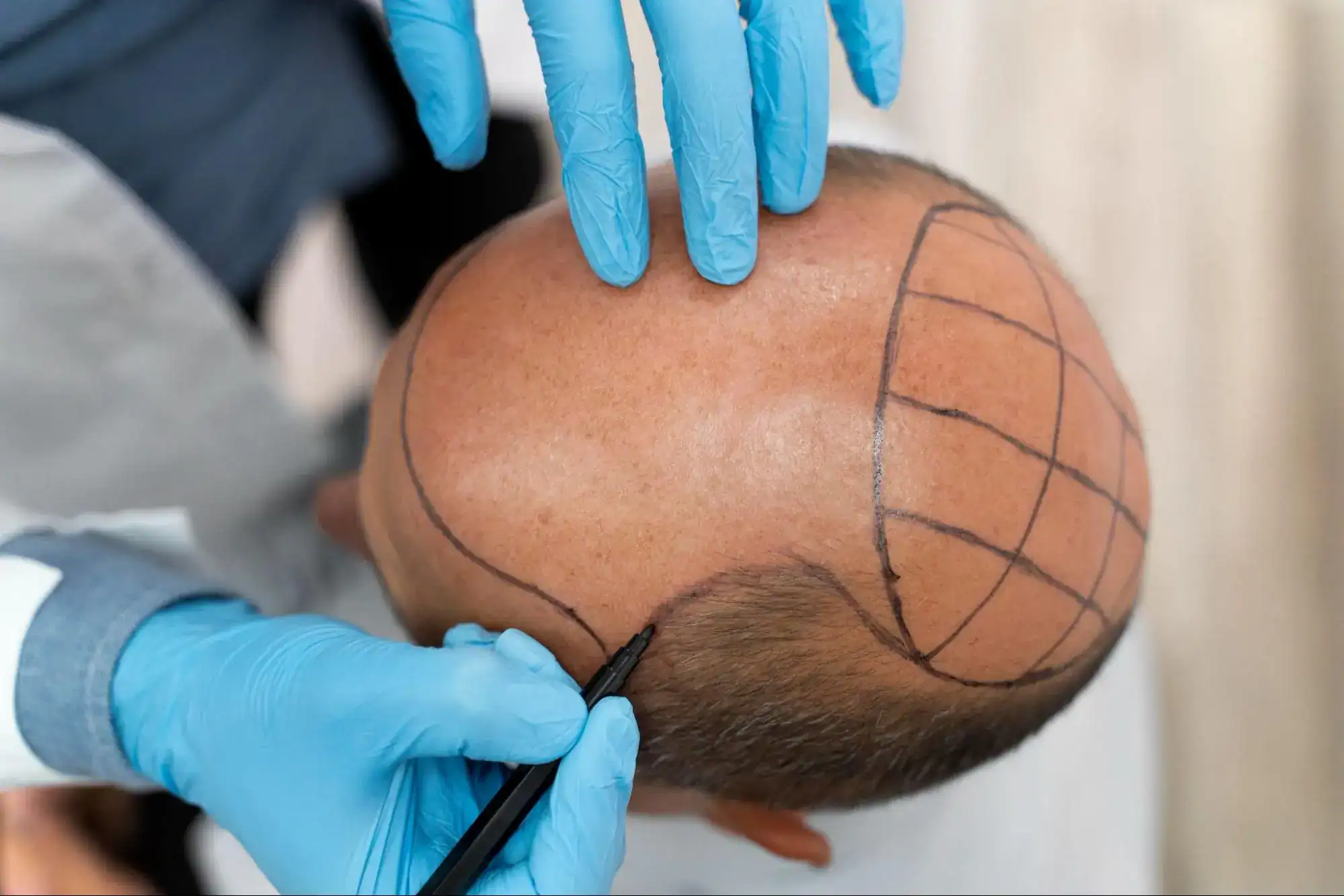 hair transplant คือ